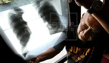 Diagnóstico tardío causa daños cerebrales a pacientes con cáncer de pulmón