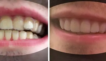 Lo que este chico hizo con sus dientes, le ahorró miles de dólares. ¡Una idea perfecta!