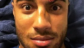 La escalofriante herida de un futbolista del Barça que recibió 12 puntos de sutura