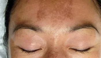 Factores que inciden en la enfermedad de melasma 