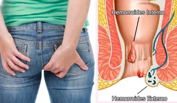 Esta receta que cura la hemorroides en 20 minutos tiene asombrados a los médicos
