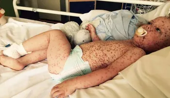 Este niño sufre del peor caso de varicela