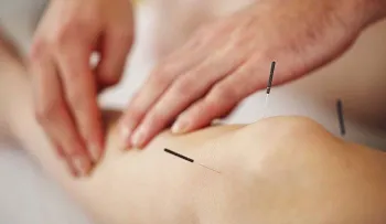 Esto pasa con tu cuerpo cuando usas la acupuntura