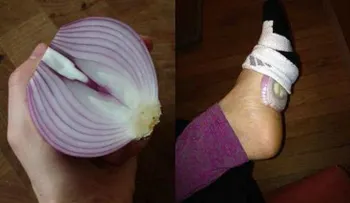 Cebollas en los pies para desintoxicar y curar gripe e infecciones ¿funciona?