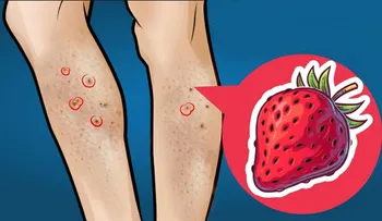 Piernas de fresa: causas y remedios caseros para deshacerte de ellas