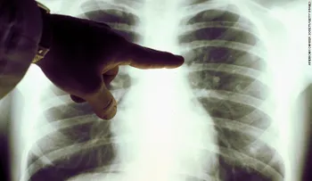 Investigadores cubanos luchan contra el cáncer de pulmón con una vacuna