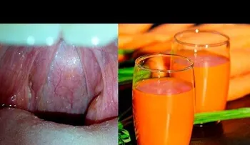 5 remedios caseros para las Amigdalas; como desinflamar las Anginas