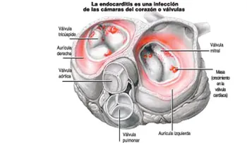 Endocarditis; causa, síntoma y prevención   (VIDEO)