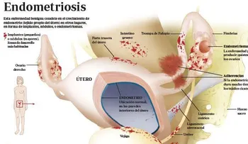 Endometriosis: Lo que no te explican y necesita saber (VIDEO)
