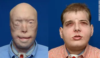 Este hombre recibió el transplante de cara más extenso de la historia