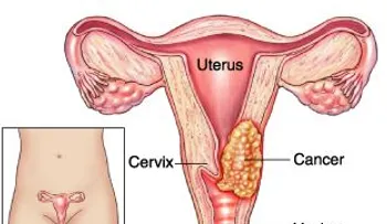 Cáncer de cuello uterino se asocia con la infección de VPH y es prevenible