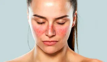 El lupus: 11 signos de que puedes estar padeciendo de esta enfermedad