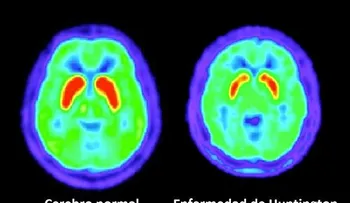 Hay dos formas de la enfermedad de Huntington; causas y tratamientos