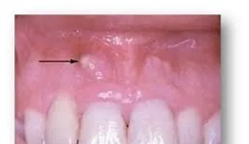  Osteomielitis (infección dental) afecta a 50 por ciento niños y puede dejar graves secuelas 