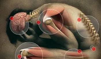 Confirman que el zika puede causar síndrome de Guillain-Barré