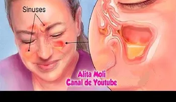 Un remedio que mata la infección de la sinusitis en 20 segundos 