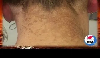 Como aclarar la piel oscura del cuello (Video)
