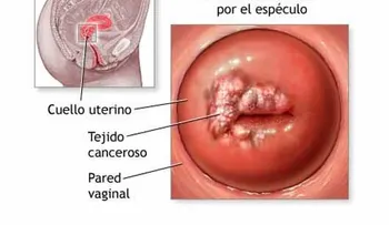 12 señales de cáncer cervical que toda mujer necesita saber