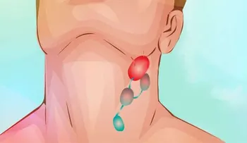 ¿Cuáles son las causas de linfoma?. Tratamiento y prevención
