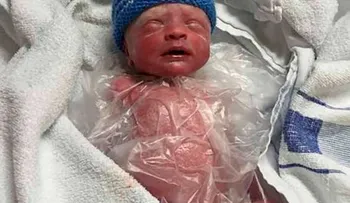 Mantuvieron vivo a un bebé prematuro en una bolsa plástica para sándwiches