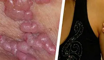 Nueva enfermedad: Más mortal para las mujeres que el sida, ni los preservativos te salvan!!!