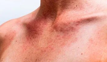 Con estas mascarillas podrás aclarar la piel en cualquier parte del cuerpo