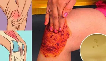 Un poderoso remedio para el dolor de rodillas, huesos y articulaciones 