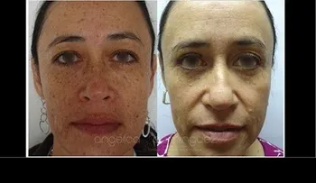 Tratamientos para manchas en la cara, axilas...(Video) 