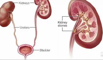 ¿Cómo deciden los médicos el mejor tratamiento para los cálculos renales? 