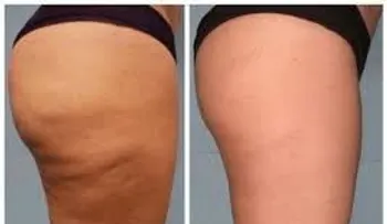 Elimina la celulitis solo con orégano y aceite de oliva 