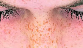 Las pecas: naturalidad y rebeldía
