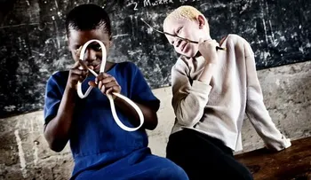 El infierno de ser albino en África