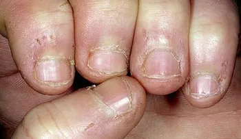Entérate: Cómo eliminar el hongo de las uñas para siempre 