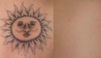 Cómo eliminar un tatuaje de tu piel del que te has arrepentido