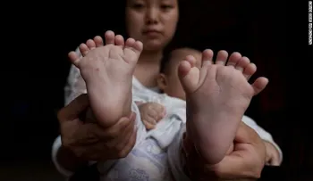 Niño chino nace con 31 dedos; sus padres buscan someterlo a cirugía