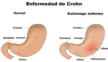 Diferencia entre intolerancia y alergia a los alimentos