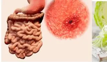 Las úlceras gastricas: 5 jugos naturales que te recubre el estómago
