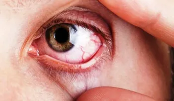 El glaucoma afectará 80 millones de personas y es una enfermedad difícil de detectar 