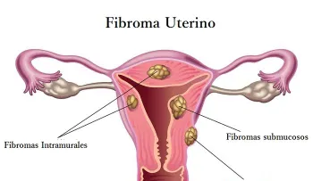 Los fibromas y cómo tratarlos