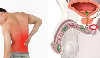 10 síntomas tempranos de cáncer en la próstata que ningún hombre debe ignorar!