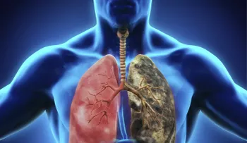 Un nuevo tratamiento aumenta la supervivencia en pacientes con cáncer de pulmón