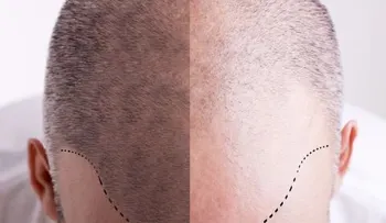 Trasplante capilar, recurso eficaz para repoblar tu pelo