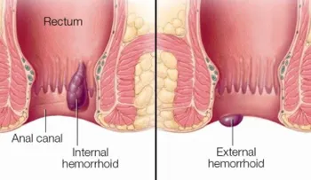 Intentar medidas de autocuidado para aliviar las hemorroides