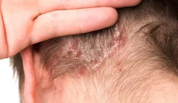 La psoriasis: Inflamación de la piel y articulaciones de carácter crónico; evita los largos baños o agua muy caliente