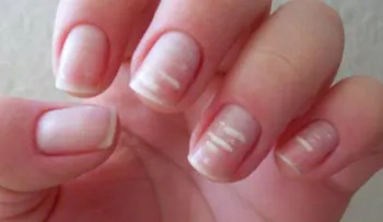 Lo que las uñas dicen de tu salud