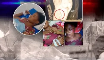 Joven de Nagua solicita traslado a Santo Domingo para cirugías tras accidente