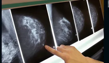 Hasta 270 mujeres pueden haber muerto por error en plan de detección de cáncer de mama en Inglaterra