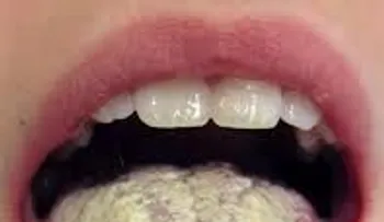 La candidiasis y sus peligros 