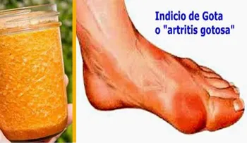 ¡Diga adiós a la gota o artritis con este remedio casero!