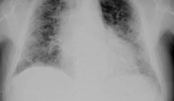 Enfermedades raras: fibrosis pulmonar idiopática (FPI)